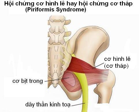 Hội chứng cơ hình lê (cơ tháp).