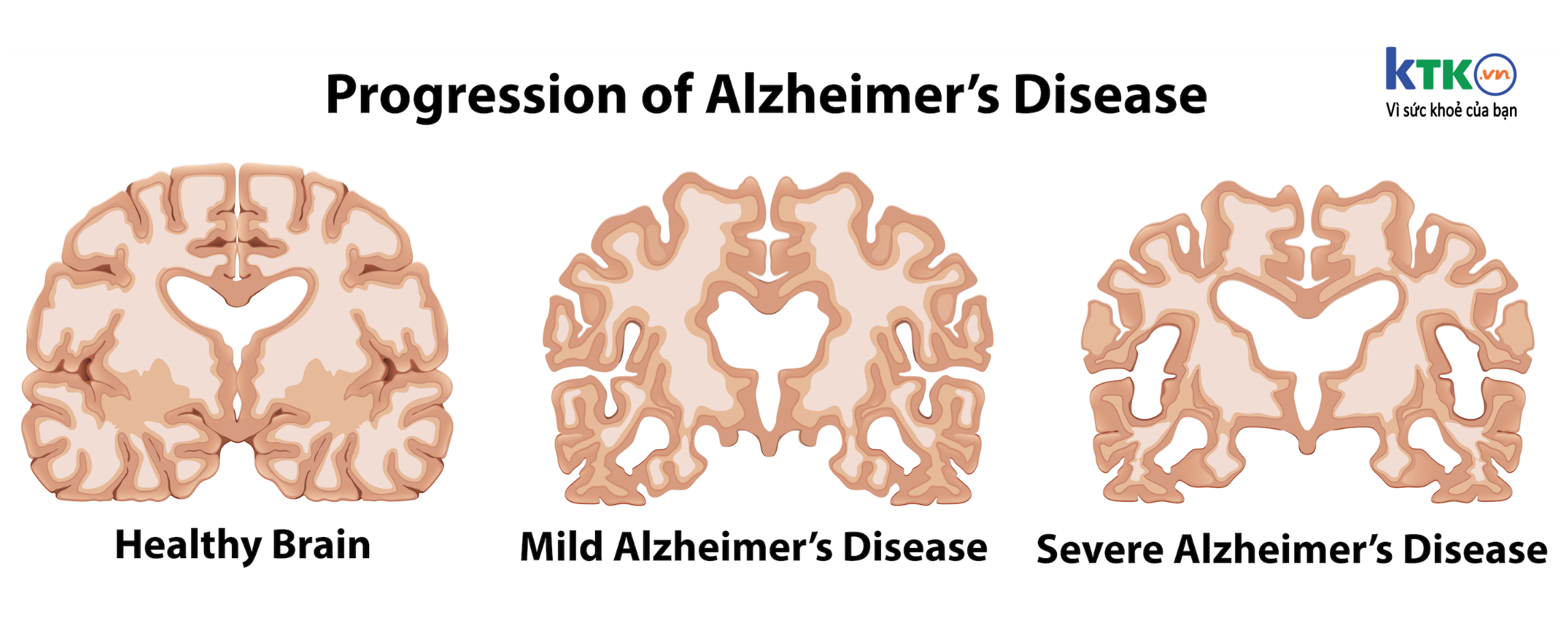 Bệnh Alzheimer’s biểu hiện như nào?