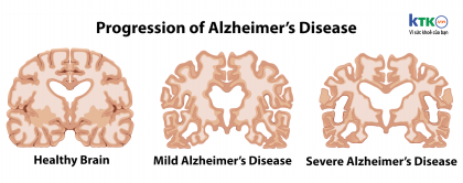 Bệnh Alzheimer’s biểu hiện như nào?