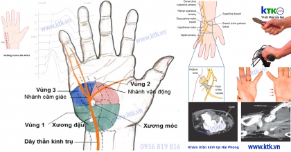 Hội chứng kênh Guyon - teo cơ ngón tay út.